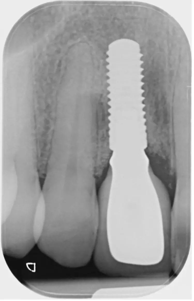 Abb. 15: Kontrollaufnahme nach definitiver
prothetischer Versorgung des
Implantats regio 11.
