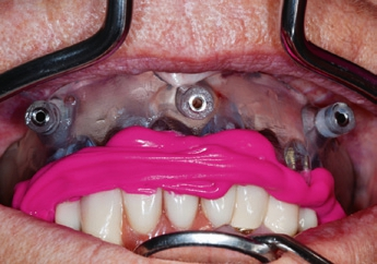 Abb. 15: Zentrisch fixierte OP-Schablone.