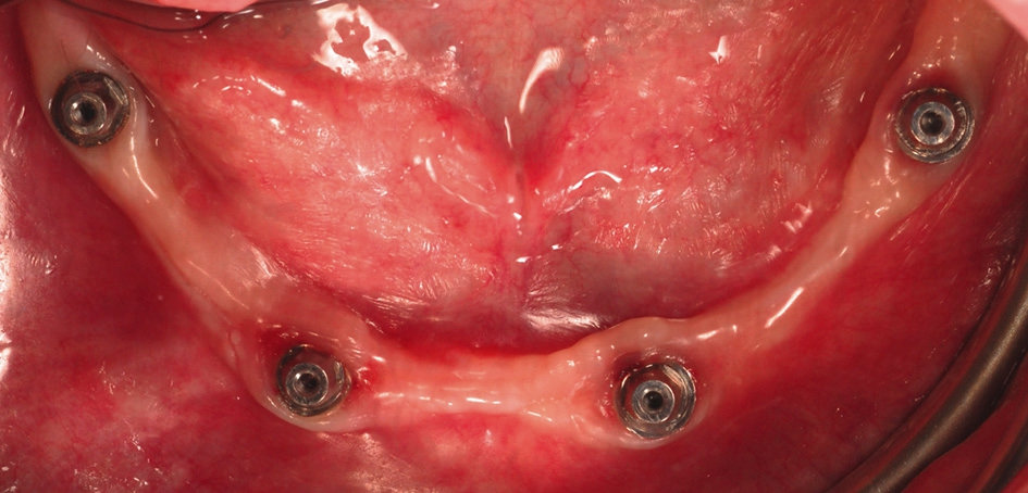 Abb. 16: PS MultiPlus-Abutments in situ.
