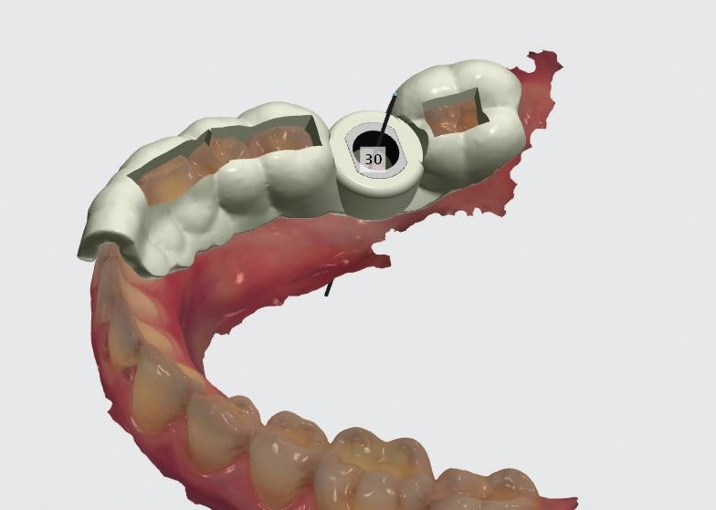 Abb. 15: Auf Grundlage des geplanten Implantates wird eine virtuelle Bohrschablone erzeugt.