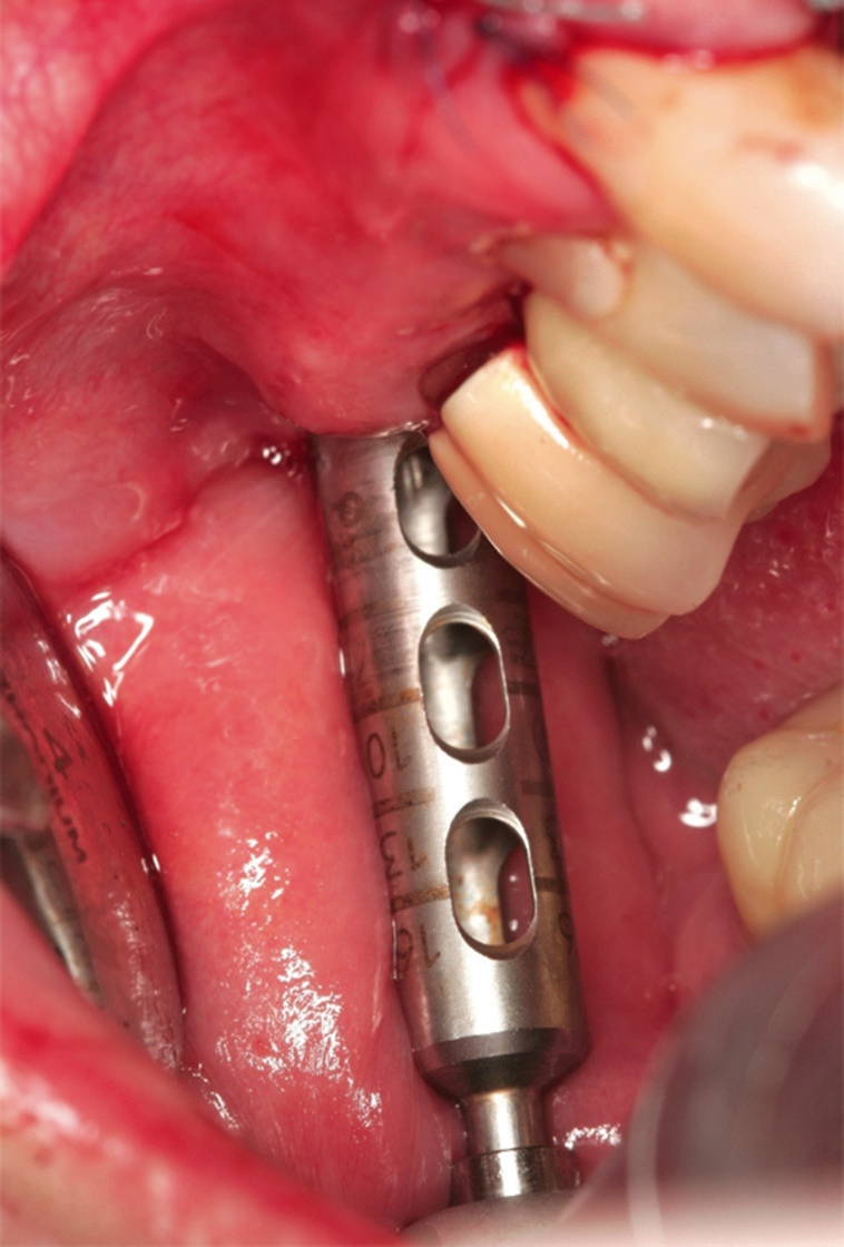 Abb. 14: Explantation eines Knochen-Schleimhaut Transplantates für die Socket Preservation.