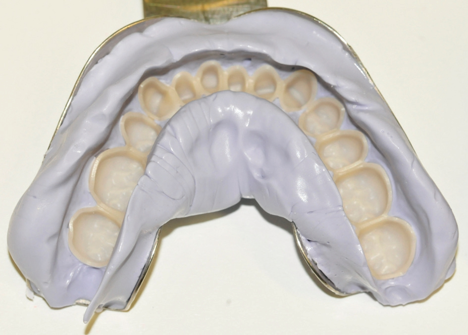 Abb. 14: Das Unterkieferprovisorium in der Abformung.