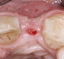 Abb. 15: Sechs Monate nach der Operation erfolgte die Freilegung des Implantats.
