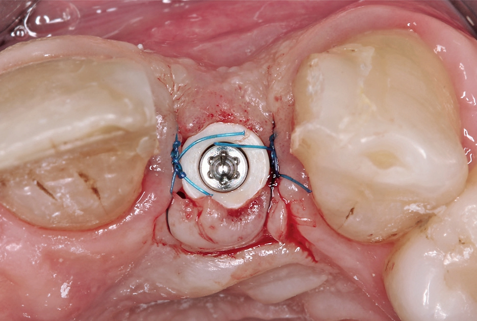 Abb. 15: Das Weichgewebe wurde mit 6-0 Prolene dicht um den Gingivaformer vernäht.