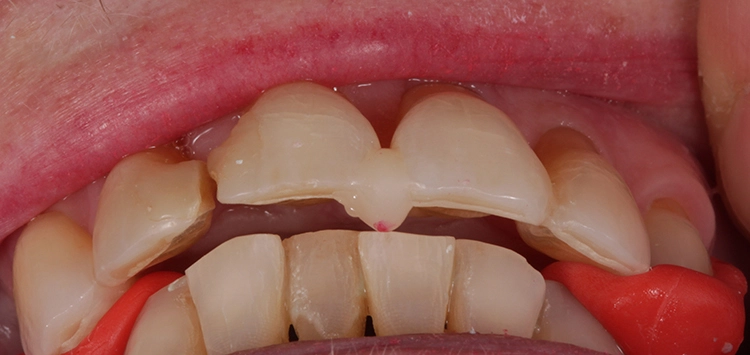 Abb. 15: Zentrikbissnahme mittels Frontjig und GC Bite Compound nach Gutowski.