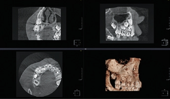 Abb. 18: MPR Ansicht DVT, zusammengesetztes Odontom.