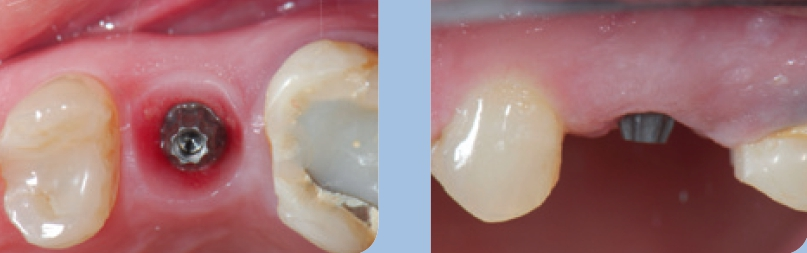 Abb. 15a u. b: Präzise ausgeformtes Emergenzprofil zu Beginn der prothetischen Phase. Die natürliche Stippelung der bukkalen Gingiva gilt als eindeutiges Indiz für stabil knöcherne Verhältnisse im bukkalen Bereich. Ansicht von okklusal und bukkal.