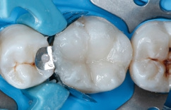 Abb. 15: Mit dem modellierbaren Ormocer Admira Fusion wird das fließfähige Bulk-Fill-Ormocer abgedeckt und die okklusale Anatomie wiederhergestellt.