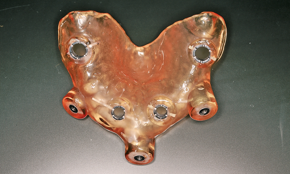 Abb. 15: Bohrschablone für den Oberkiefer.