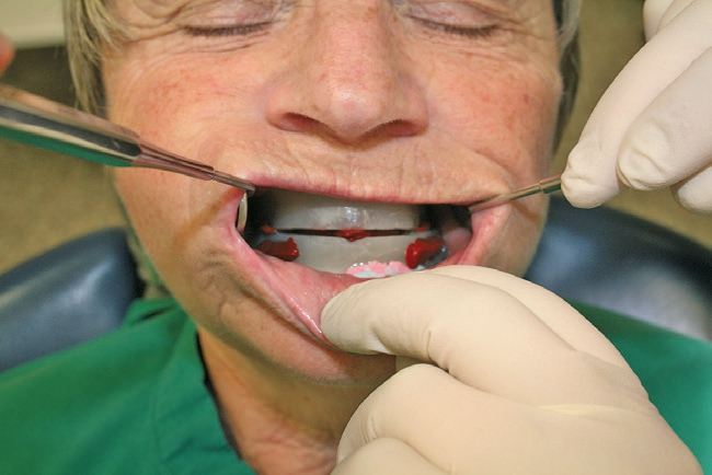 Abb. 10: Montage der Vorzentrik im Patientenmund und Überprüfung.