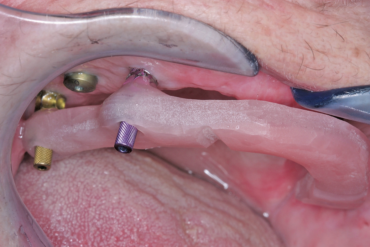 Abb. 14: Durch eine verschraubte Bissnahme erreicht man die optimale Übertragung der intraoralen Situation auf das Meistermodell und erspart sich damit später unnötiges, zudem zeitaufwendiges Einschleifen am Patienten.