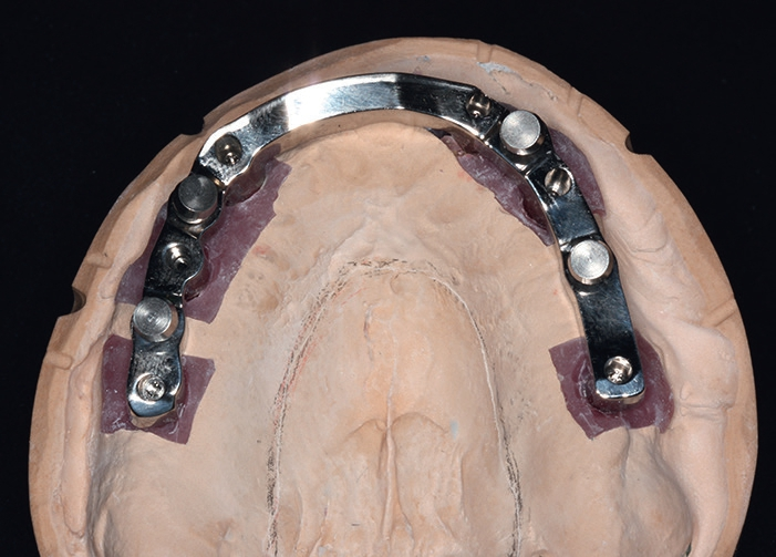 Abb. 15: Fertigung des Steges auf Abutmentniveau.