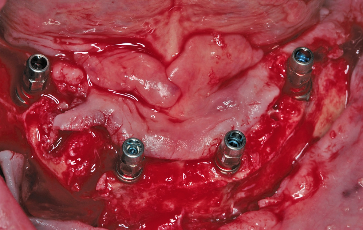 Abb. 13: Zustand nach Insertion aller Implantate im Unterkiefer.