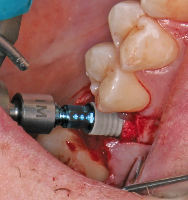 Abb. 15: Insertion des Implantats in den Knochenring.