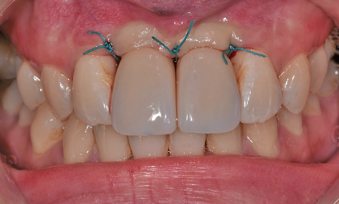 Abb. 16: Klinische Situation unmittelbar nach der Kronenplatzierung. Die mandibuläre Protrusion ist gelöst.