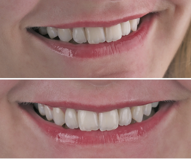 Abb. 15 u. 16: Das Ergebnis im Zahnbogen.