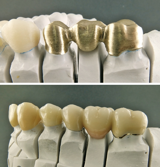Abb. 42 u. 43: Bei Zahn 16 wurde auf ein Implantat verzichtet, da die Knochenverhältnisse hierfür nicht ausreichten und dem Patienten Augmentationsmaßnahmen erspart werden sollten. In dieser Region wurde die Lücke mit einer klassischen VMK-Brücke geschlossen (Edelmetall-Gerüst aus 63Z8/Teamziereis, Engelsbrand, mit der Keramikverblendung VM15/Vita Zahnfabrik).