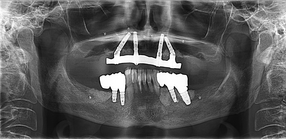 Abb. 15: Übersichtsaufnahme als Baseline-Röntgen für zukünftige Kontrollen.