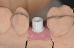 Abb. 16: Meistermodell mit modifiziertem Abutment.