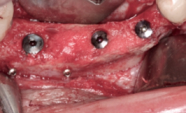 Abb. 15: Die Nachimplantation.