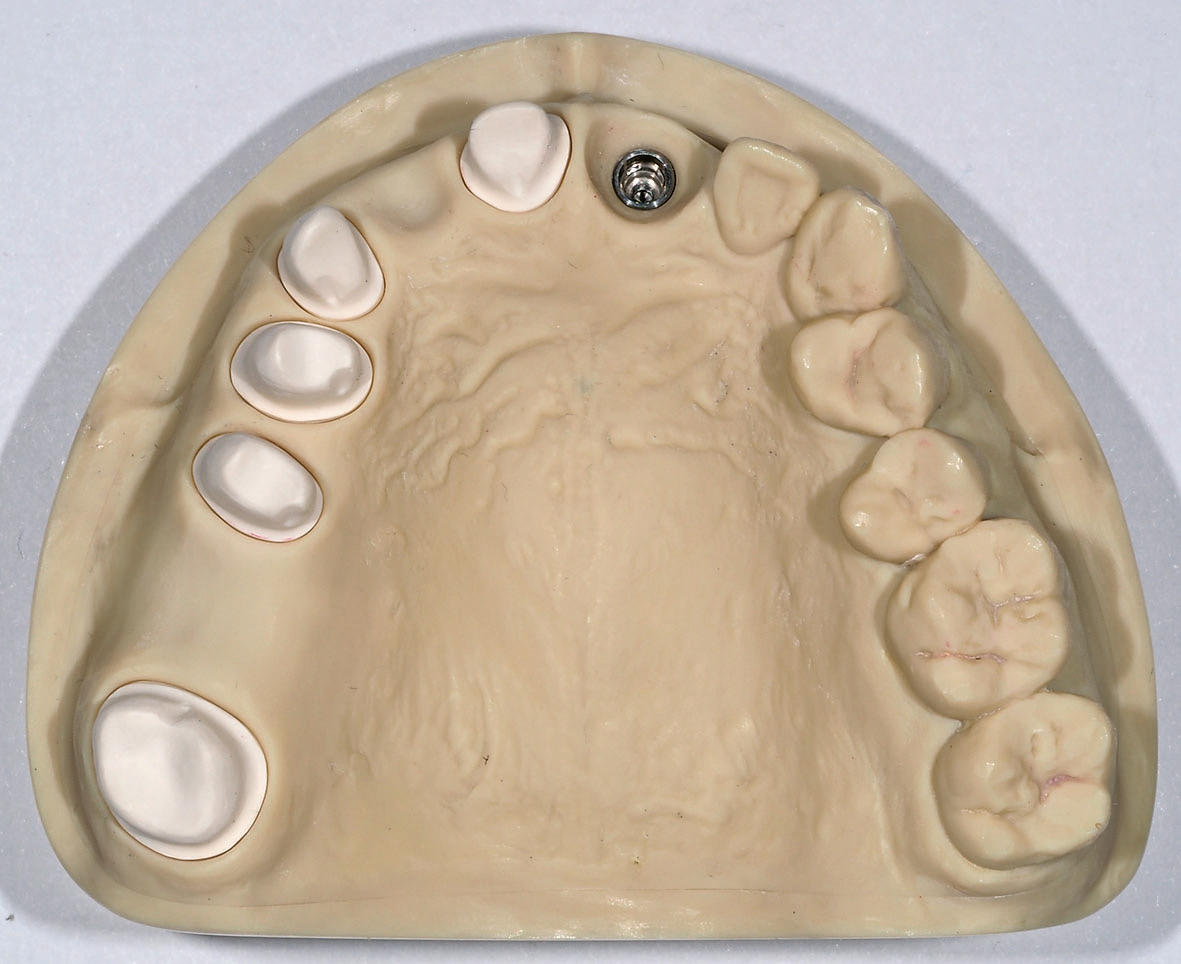 Abb. 15a: Modell mit präparierten Stümpfen und Laboranalog des Implantats.