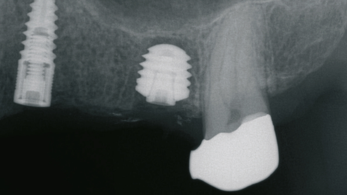 Abb. 15: Röntgenkontrolle nach Insertion eines durchmesserreduzierten Implantates (narrowSky, bredent medical) in Kombination mit einem ultrakurzen Implantat (copaSky).
