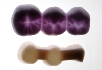 Abb. 7a: 3-gliedrige implantatgetragene vollkeramische Seitenzahnbrücke von 35 bis 37 zum Ersatz des Zahnes 35 (Prämolarenbreite). Nach der vollanatomischen Konstruktion der Brücke wurden in der Software ein sog. „File-Splitting“ durchgeführt und eine digitale Verblendung aus Lithiumdisilikatkeramik (IPS e.max CAD, HT) angefertigt, die mit dem darunterliegenden Gerüst aus Zirkoniumoxidkeramik versintert wurde (CAD-on-Technik).