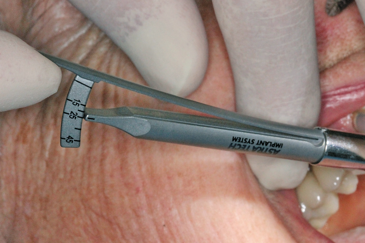 Abb. 15: Festziehen des Abutments auf dem Implantat mit dem Drehmomentschlüssel.