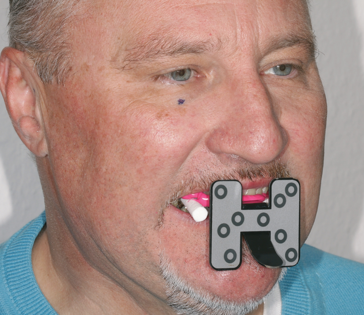 Abb. 10a: Beim Gesichtsscan trägt der Patient ein spezielles Bite Tray.