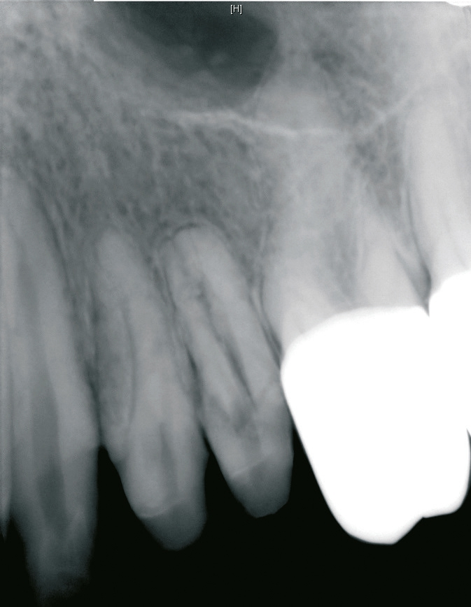 Abb. 15: Intraoraler Zahnfi lm 25 – Verdacht auf eine zervikale Resorption.