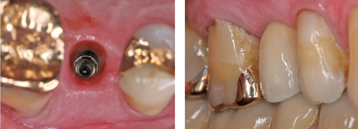 Abb. 17 und 18: Einsetzen der implantatprothetischen Restauration über die selbsthemmende, konische Innenverbindung (zementfreie Eingliederung).