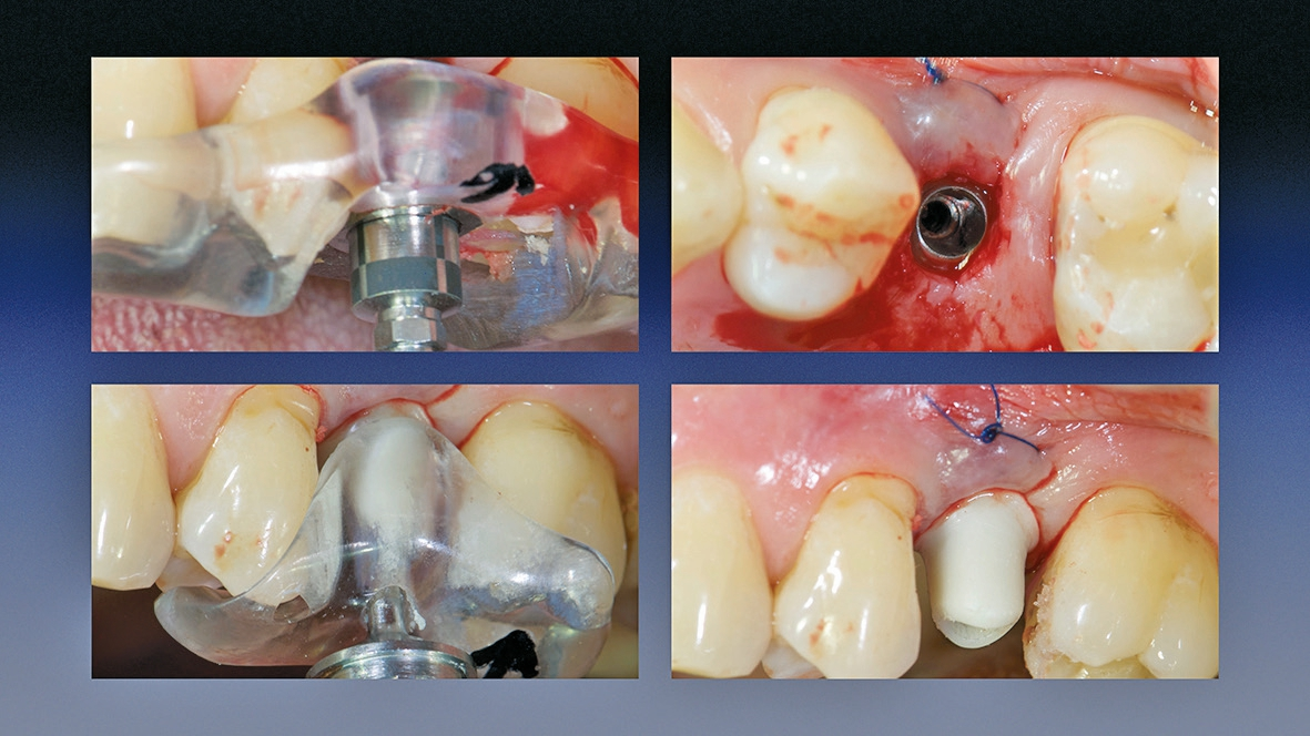 Abb. 13: Implantatinsertion und Platzierung des Abutments.