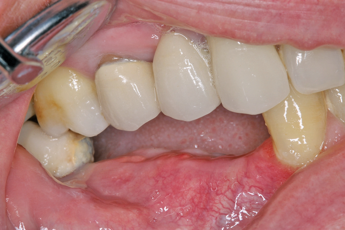 Abb. 15: Klinische Situation 10 Wochen nach Implantatinsertion: erfolgreiche horizontale Alveolarkammaugmentation.