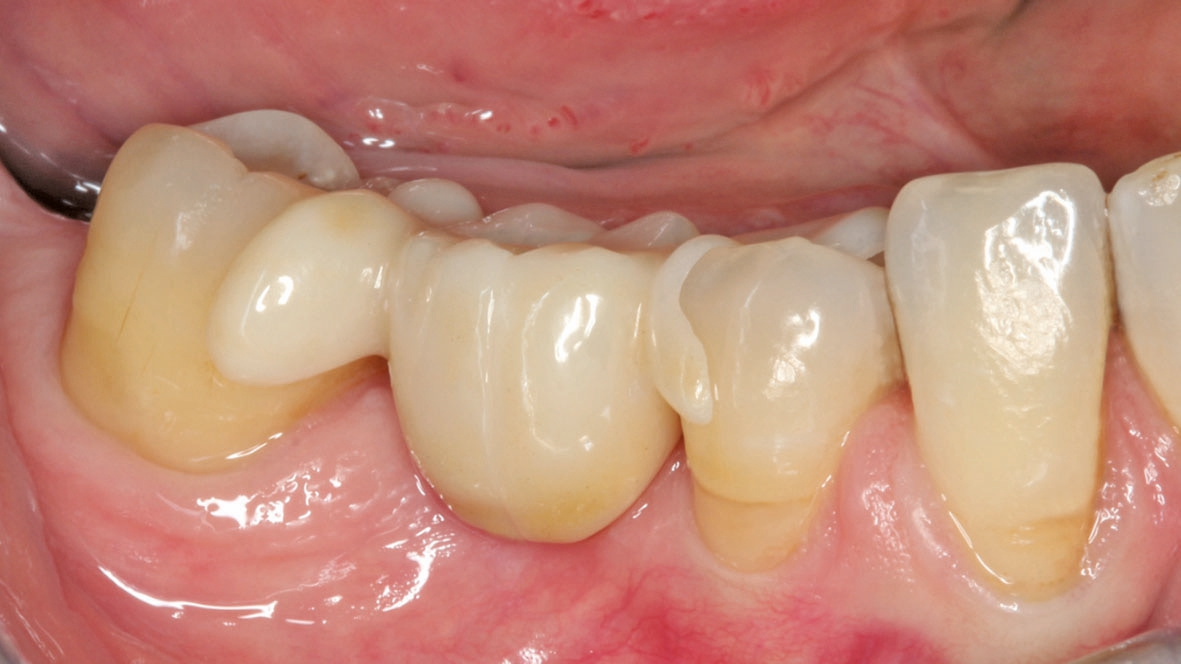 Abb. 11: Der Molar 46 aus Zirkoniumdioxid wurde mittig geteilt. Die zwei Flügel wurden lateral mit einem Zementierungsschlüssel adhäsiv befestigt.