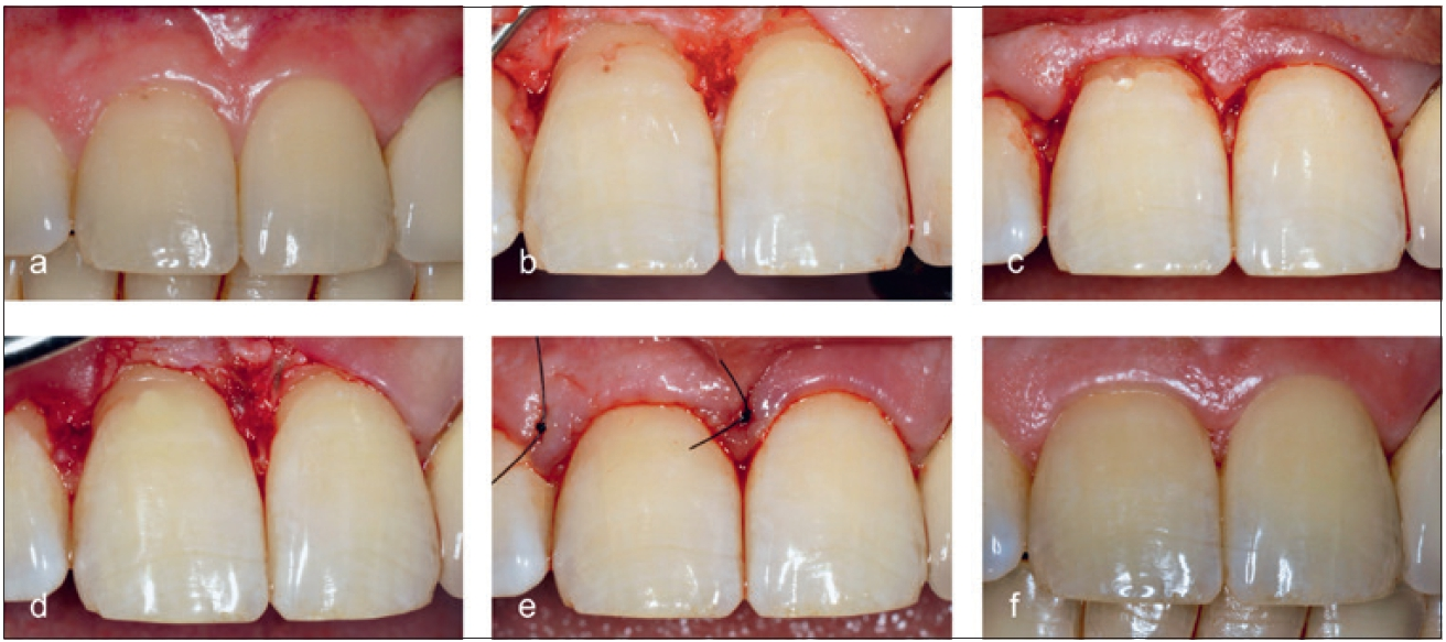 Abb. 14a: Initiale invasive zervikale Resorption am Zahn 11. b: Chirurgischer Zugang. c: Indirekte Überkappung. d: Adhäsive Restauration mit Komposit. e: Wundverschluss. f: Klinischer Zustand nach 4 Wochen.
