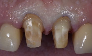 Abb. 17: Präparierung für den CEREC-Scan.