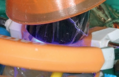 Abb. 15: Platzierung des Lichtleiters auf dem zu versorgenden Zahn.