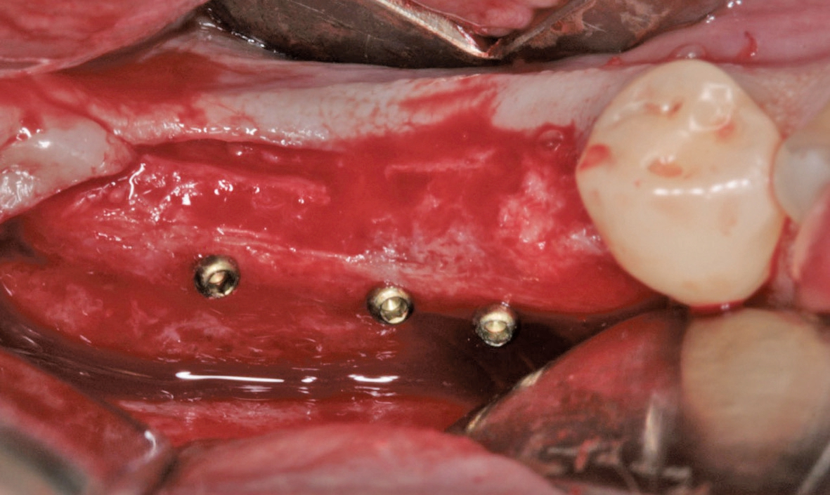 Abb. 16: Der gut revaskularsierte Knochen im Unterkiefer rechts. Keine erkennbare Resorption im Bereich der Fixationsschrauben.