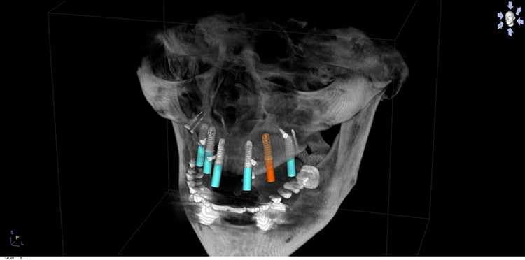 Abb. 15: Implantatplanung.