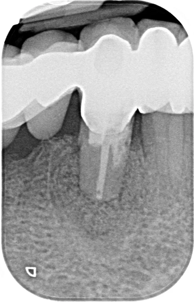 Abb. 15: Röntgenologisch ist im Bereich der aufgefüllten Stelle eine Konsolidierung
mit Knochenregeneration nach 3 und 12 Monaten zu erkennen.
