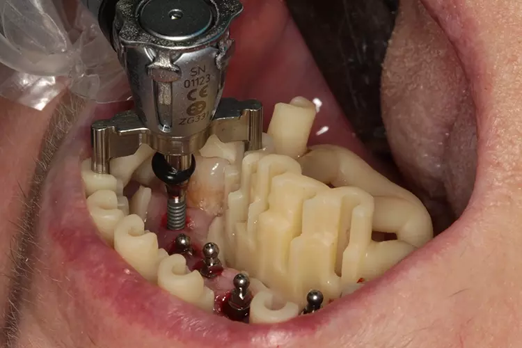 Abb. 14: Maschinelle Implantatposition.