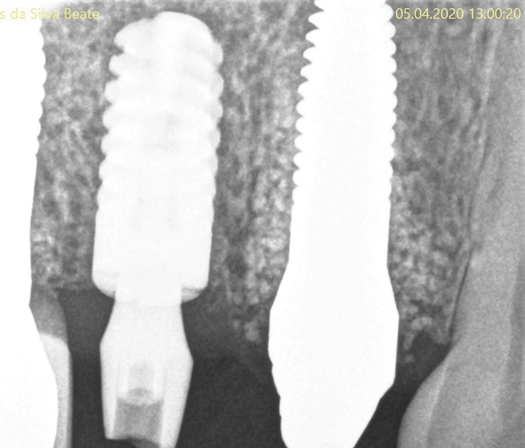 Abb. 16: Röntgenkontrollaufnahme nach Implantation.
