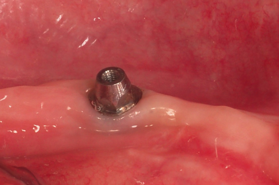 Abb. 17: Nahaufnahme PS MultiPlus-Abutment.