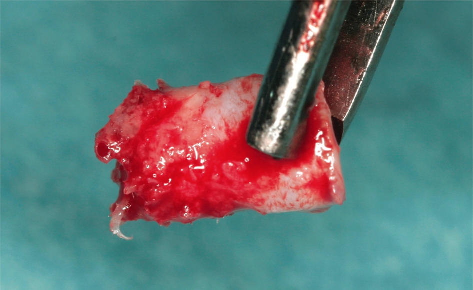 Abb. 15: Knochen-Schleimhaut-Transplantat.
