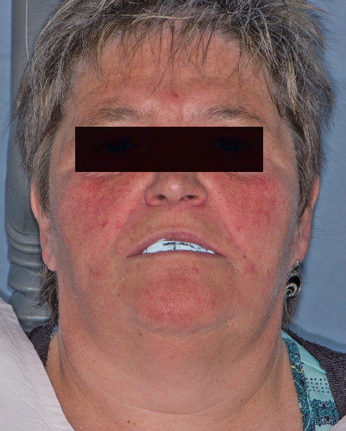 Abb. 16: Markierung der Ästhetiklinien.