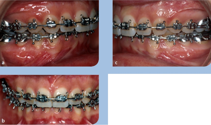 Abb. 14a–c: Klinische Situation nach der orthodontischen Vorbereitung. Die Zahnbögen wurden so ausgeformt, dass keine dentale Kompensation der skelettalen Dysgnathie mehr besteht; der tiefe Biss und die Spee-Kurve blieben weitgehend unverändert.