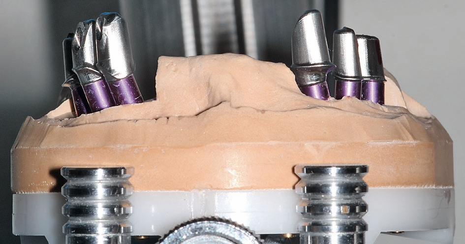 Abb. 25: Die fertig gefrästen Abutments wurden direkt nach dem Abtrennen aus dem Rohling aufgeschraubt.