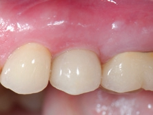 Abb. 16: Harmonischer Gingivaverlauf und stabile Verhältnisse fünf Jahre nach Eingliederung der prothetischen Versorgung.