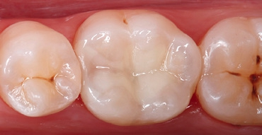 Abb. 16: Endsituation: fertig ausgearbeitete und hochglanzpolierte Ormocer-Restauration. Die Funktion und Ästhetik des Zahnes sind wiederhergestellt.