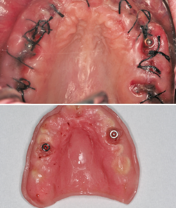 Abb. 17 und 18: Anderer Patientenfall: In den zahnlosen Oberkiefer wurden sechs Standard-Implantate und übergangsweise zwei CITO mini®-Implantate zum Befestigen des provisorischen Zahnersatzes inseriert.